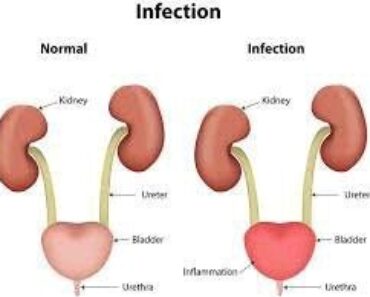 Urinary Tract Disease Kill Fast: Avoid Taking Too Much Of These 3 Things If You Want To Live Longer.